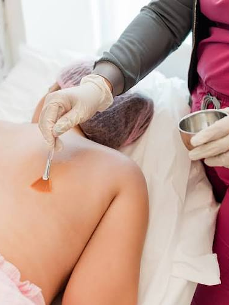  Peeling Químico Espalda 1