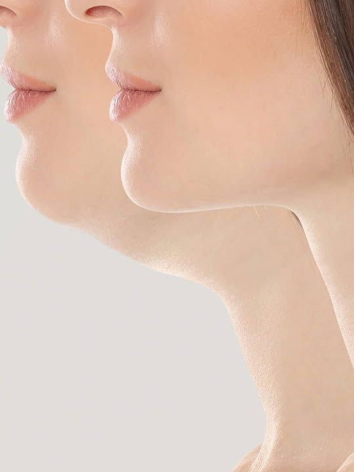 Tratamiento Reducción de Papada 1