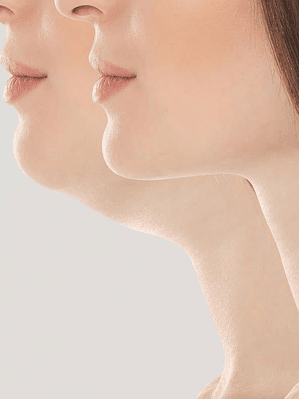 Tratamiento Reducción de Papada