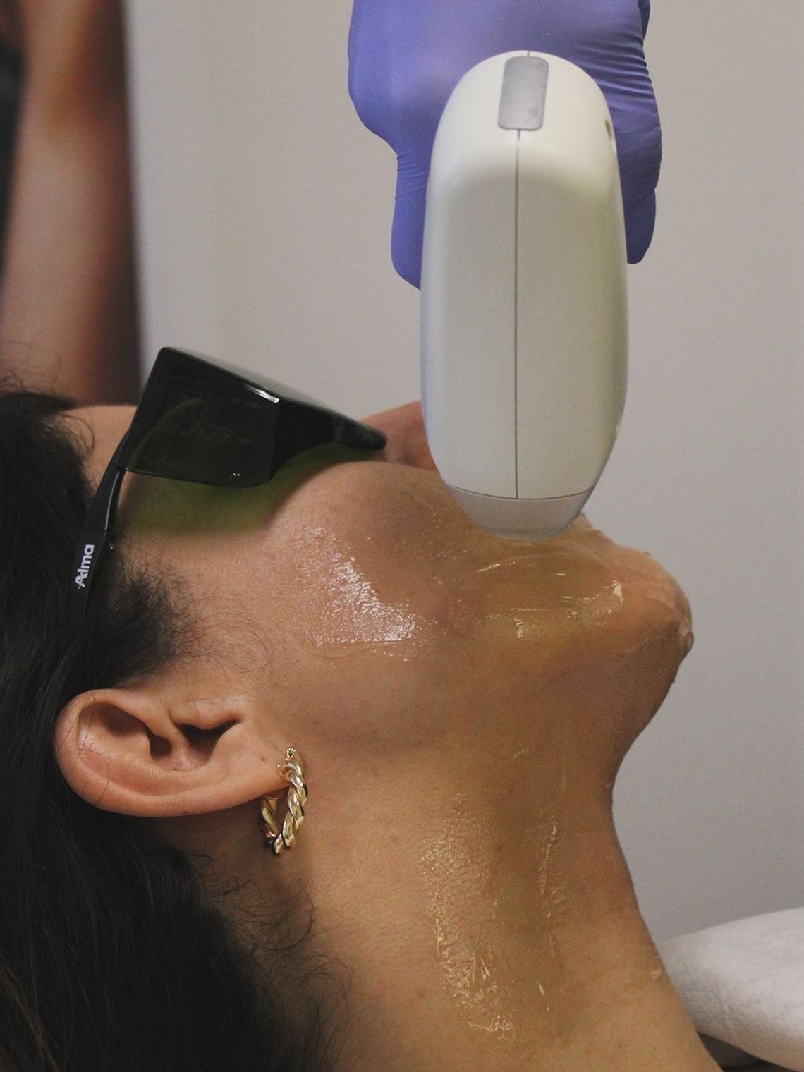 Depilación Láser Facial 1