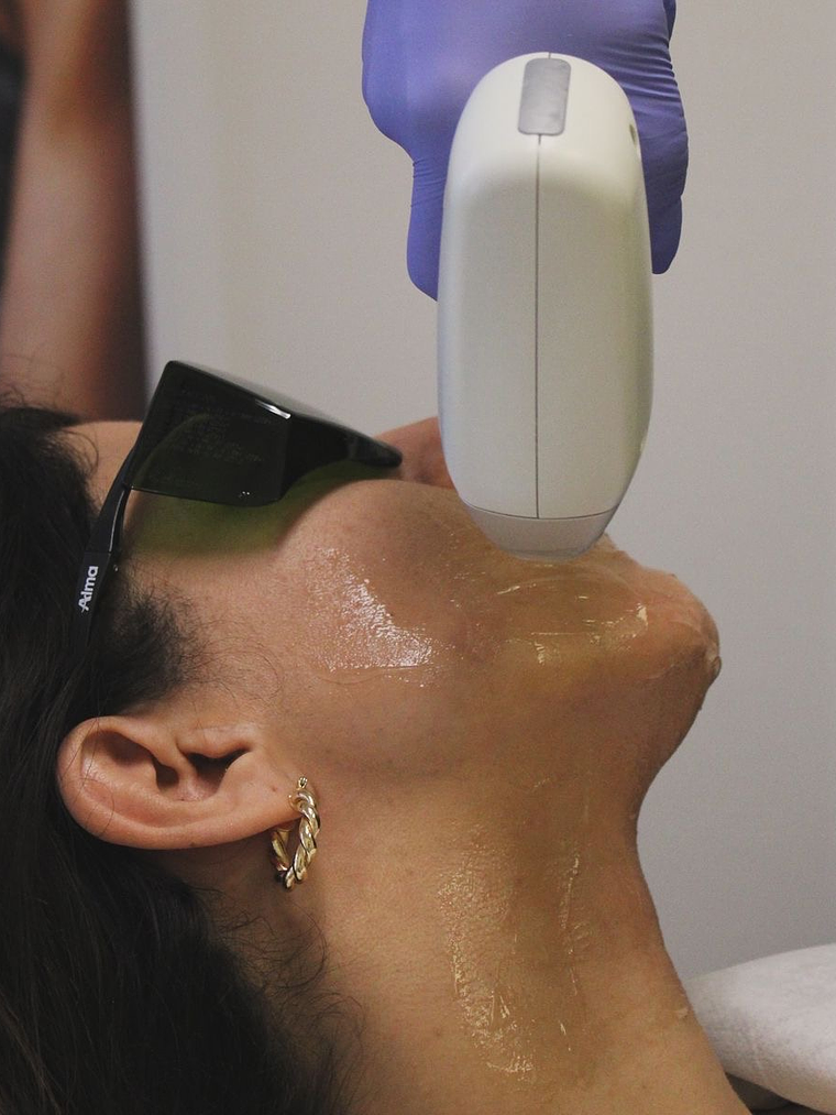 Depilación Láser Facial 1