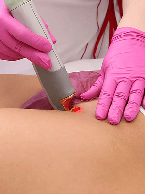 Depilación Láser Línea de Bikini