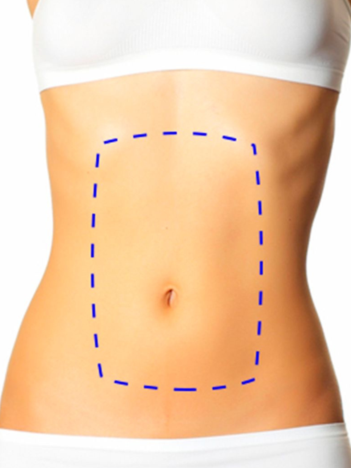 Depilación Láser Abdomen 1