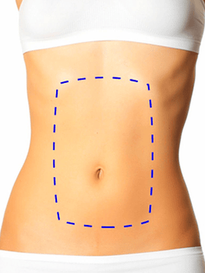 Depilación Láser Abdomen