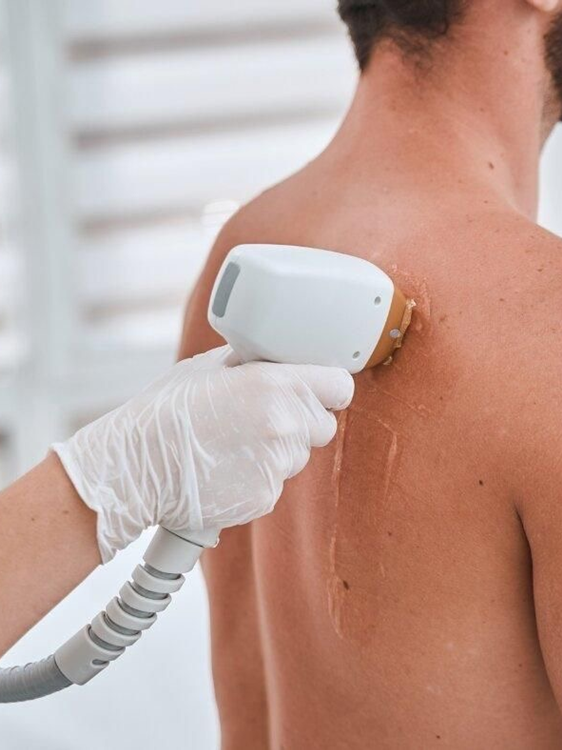 Depilación Láser Espalda Completa 1