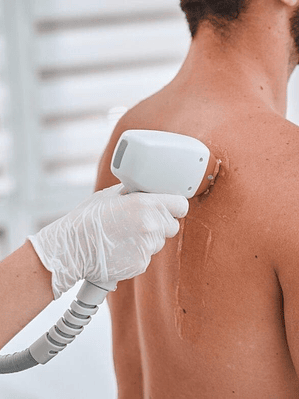Depilación Láser Espalda Completa