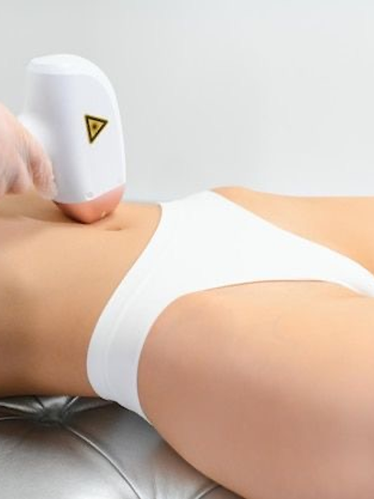 Depilación Láser Abdomen (zona amplia) 1