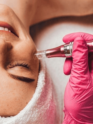 PDRN con Microneedling