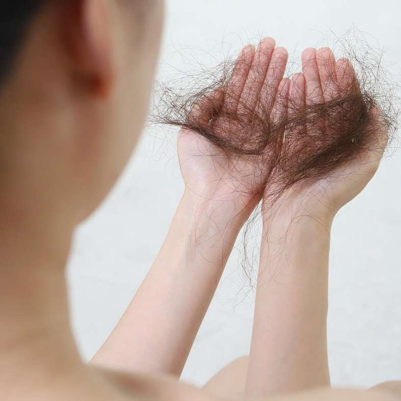 Capilares y Alopecia