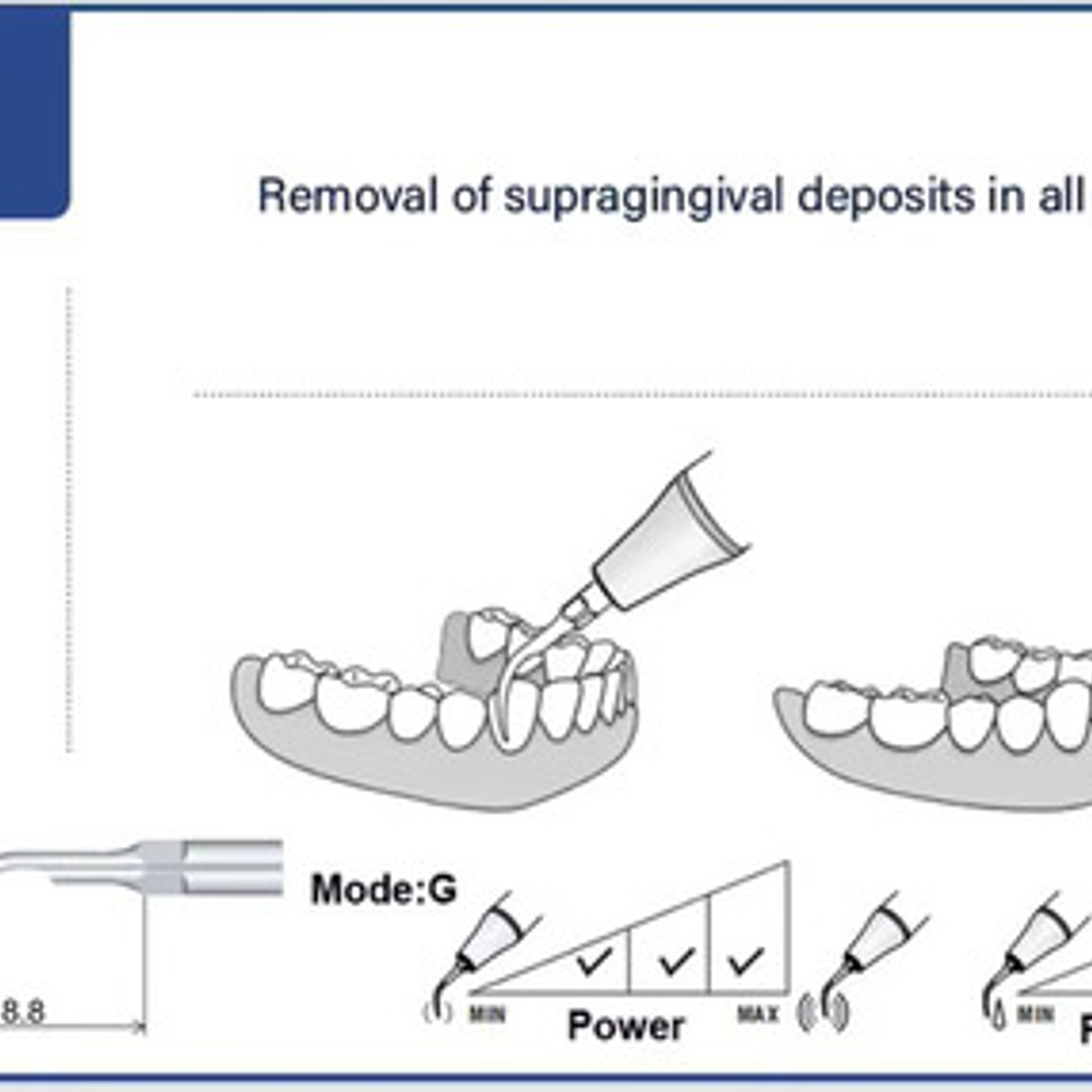 Pack 5 Puntas Scaler Ultrasonido, Dte Satelek Nsk, Gd1 Pd1 3