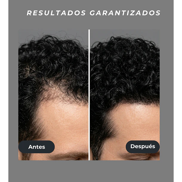 Venus Vita-X: Casco Láser (LLLT) fortalece el folículo desde la raíz. 6