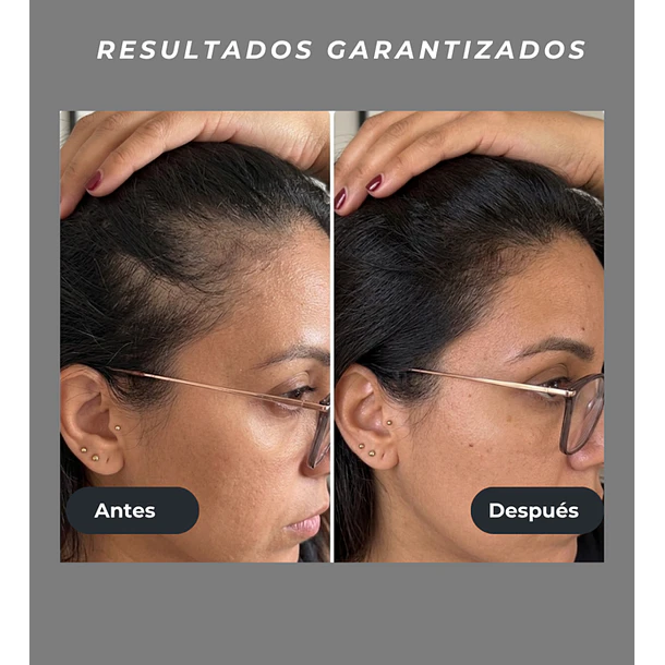 Venus Vita-X: Casco Láser (LLLT) fortalece el folículo desde la raíz. 7