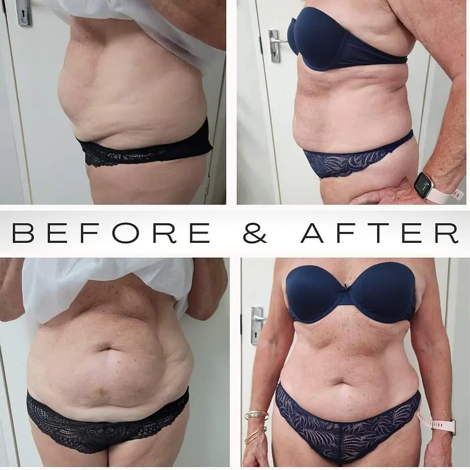 5 VIALES  LIPO LAX + 10 ML   CUERPO Y PAPADA 4