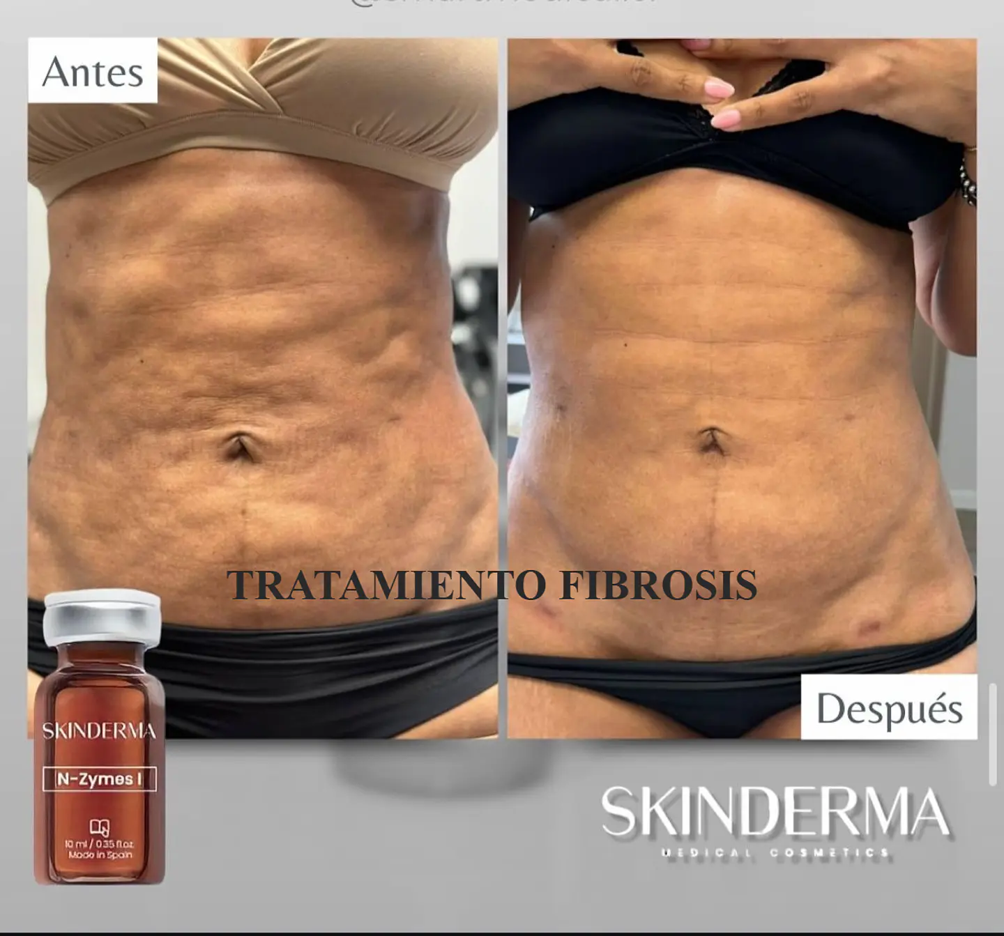 Caja de 5 viales de 10ml. N zymes 5 viales 10ml 1500 ui liofilizado  2