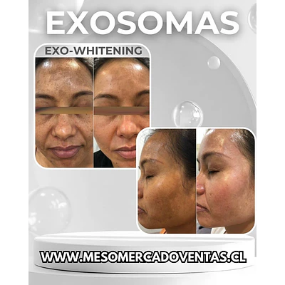 1 VIAL 10ML EXOSOMAS Whitening Liofilizado 1500 UI