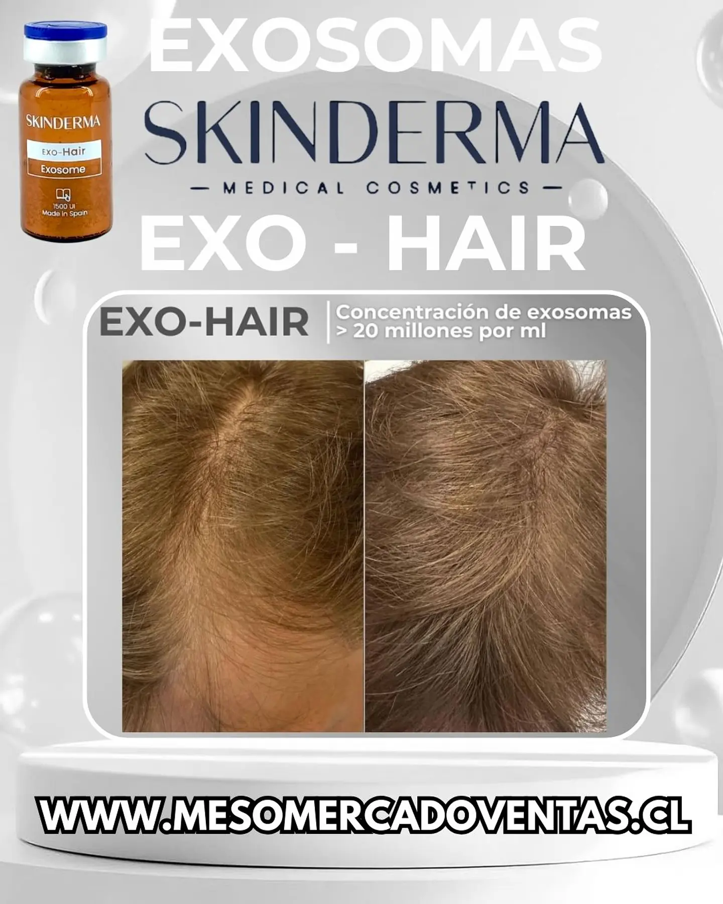 1 VIAL 10ML EXOSOMAS HAIR Liofilizado 1500 UI 4