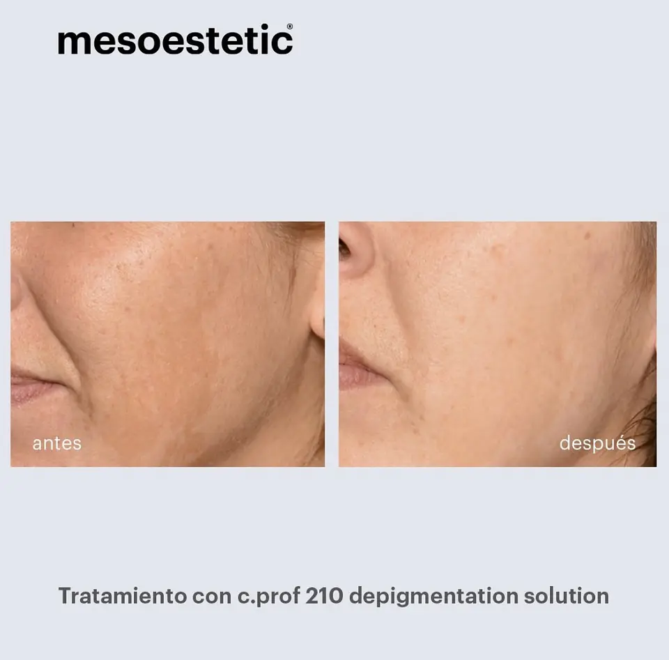 caja 5 viales 5 ml despigmentante solución 210 mesoestetic  8