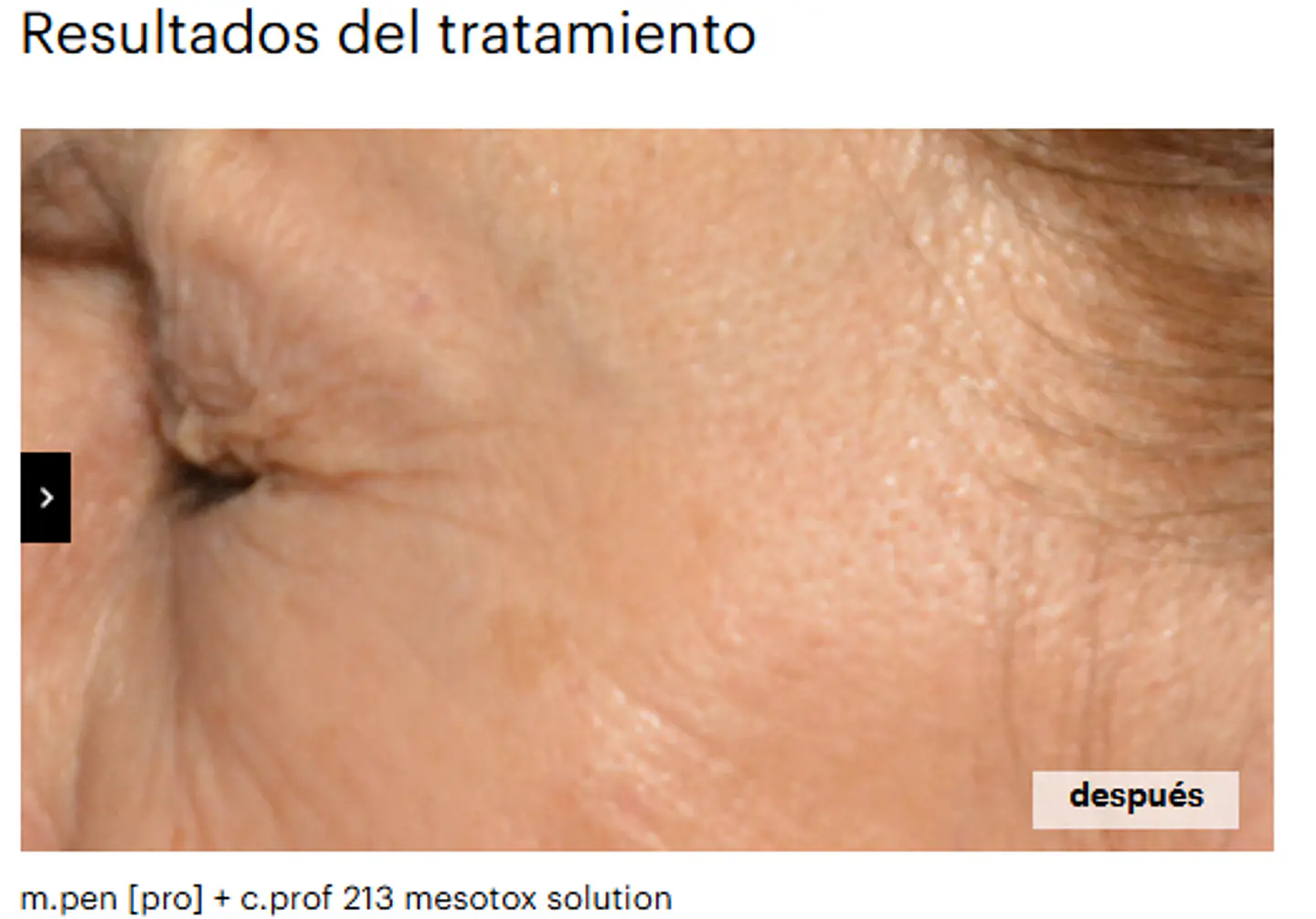CAJA 5 x 5 ml c.prof 213 mesotox solution  Exclusiva combinación de péptidos ( ARRUGAS) 3