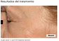 CAJA 5 x 5 ml c.prof 213 mesotox solution  Exclusiva combinación de péptidos ( ARRUGAS) - Miniatura 3
