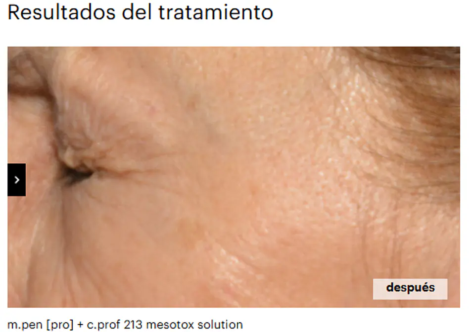 CAJA 5 x 5 ml c.prof 213 mesotox solution  Exclusiva combinación de péptidos ( ARRUGAS) 3