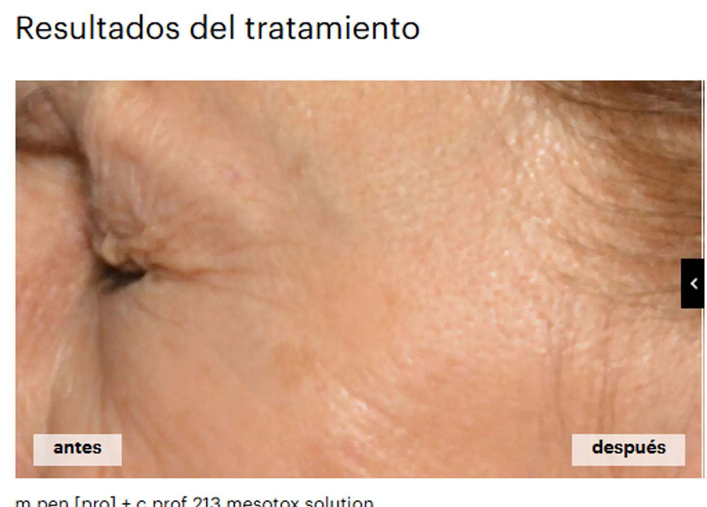 CAJA 5 x 5 ml c.prof 213 mesotox solution  Exclusiva combinación de péptidos ( ARRUGAS) 4