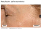 1 VIAL  x 5 ml c.prof 213 mesotox solution  Exclusiva combinación de péptidos ( ARRUGAS) - Miniatura 4
