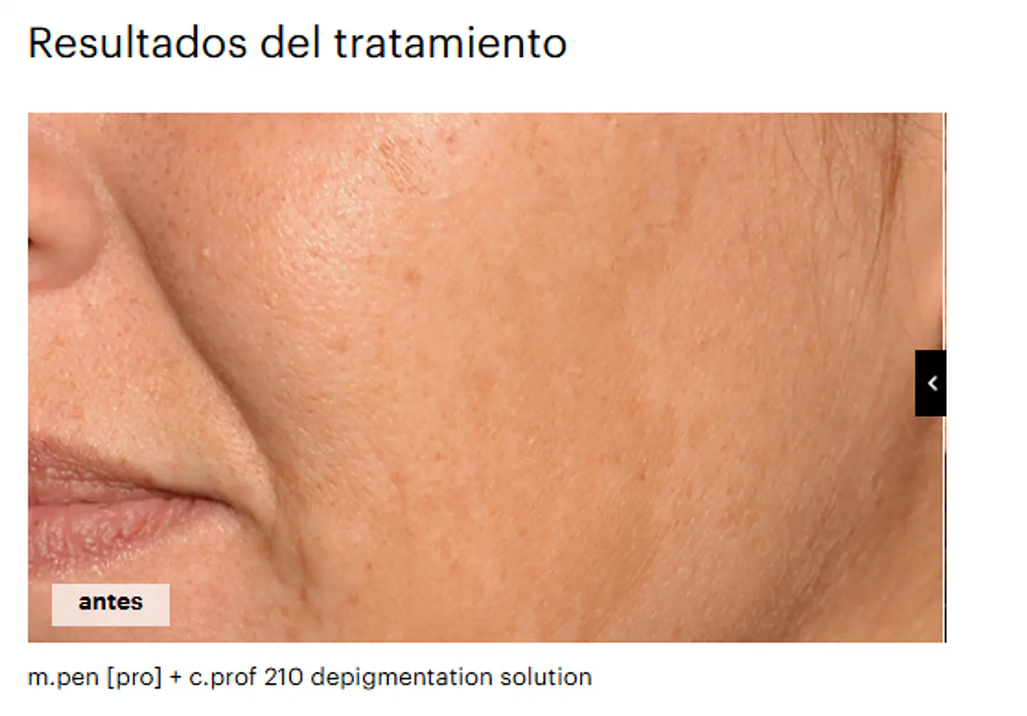 1 VIAL X 5ML  C.PROF 210  DESPIGMENTATION SOLUCION ( efecto iluminador y antioxidante. Unifica el tono de piel.) 3