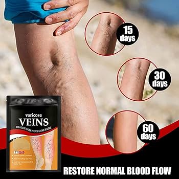 Parches para varices 2