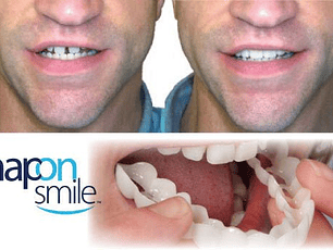 Dientes postizos Carillas