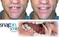 Dientes postizos Carillas - Miniatura 2
