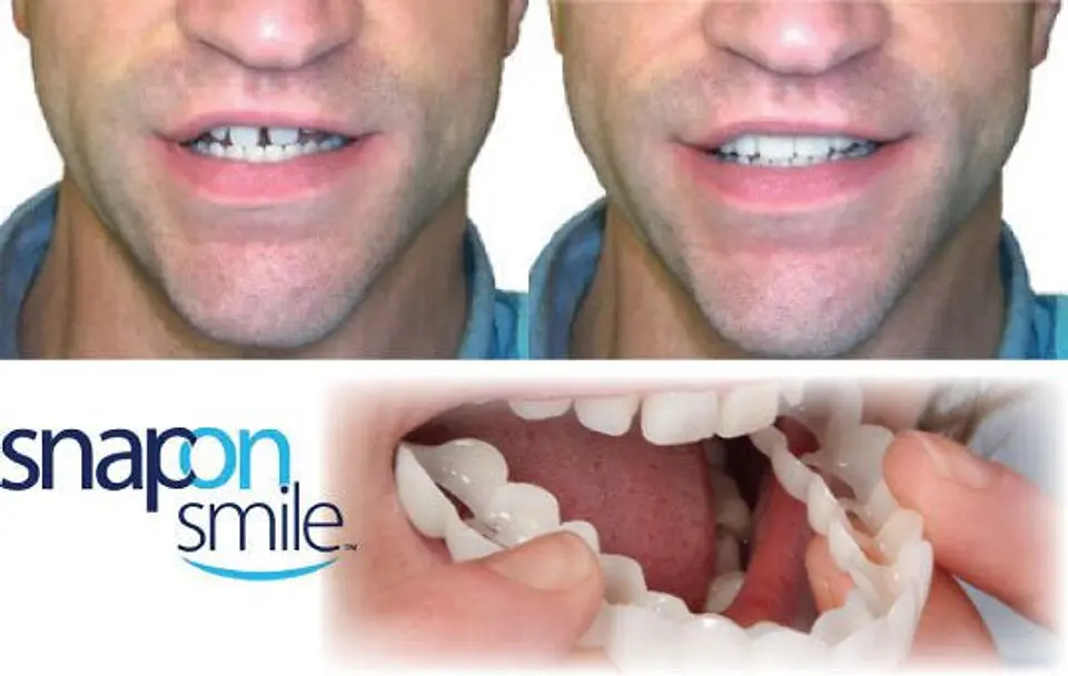 Dientes postizos Carillas 2