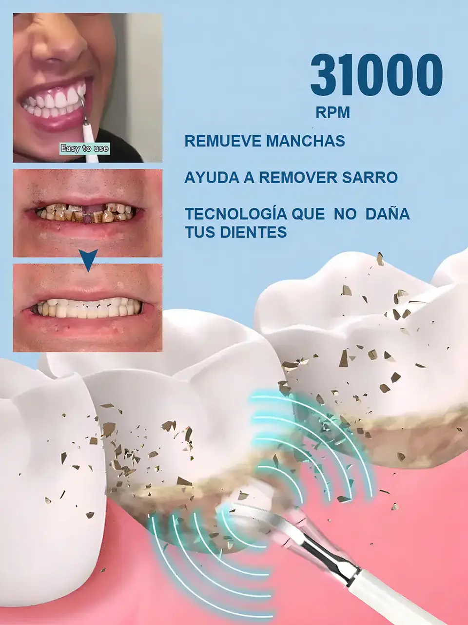 Cepillo Dental Eléctrico Kit Limpiador De Dientes Ultrasónico Mohits Removedor De Sarro Portátil Usb Blanco 2