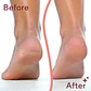 Exfoliadores y limas electrónicas para manicura y pedicura Electric Pedi Removedor Dureza - Miniatura 3