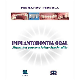 Implantodontia Oral Alternativa Para Uma Prótese Bem suced