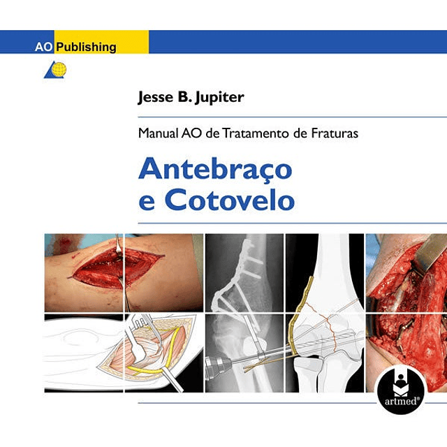 Manual Ao De Tratamento De Fraturas Antebraço E Cotovelo