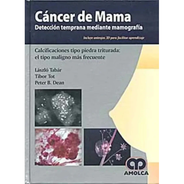 Cancer de Mama con anteojos de 3 D