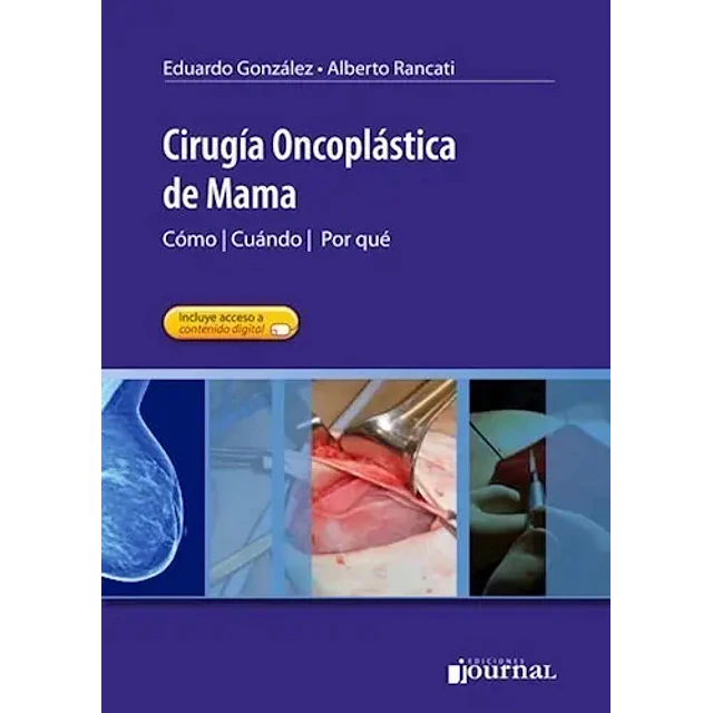 Cirugía Oncoplástica de Mama