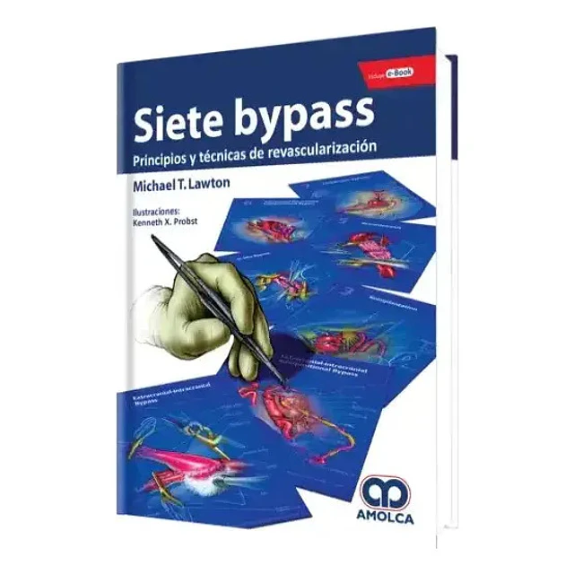 Siete Bypass