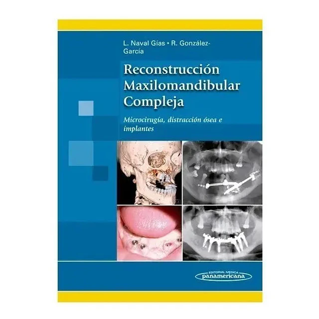 Reconstrucción Maxilomandibular Compleja