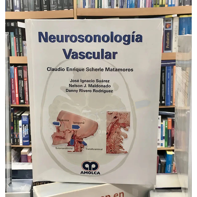 Neurosonología Vascular