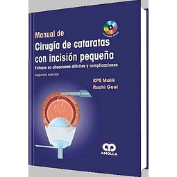 Manual de Cirugía de cataratas con Incisión Pequeña