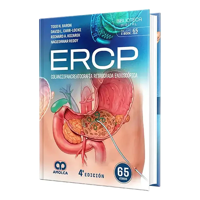 ERCP colagiopancreatografía retrógrada endoscópica
