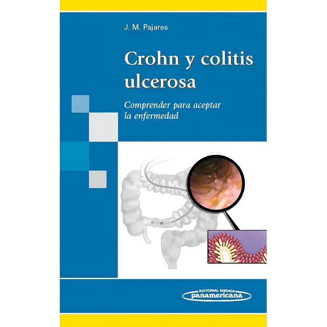Crohn y colitis ulcerosa