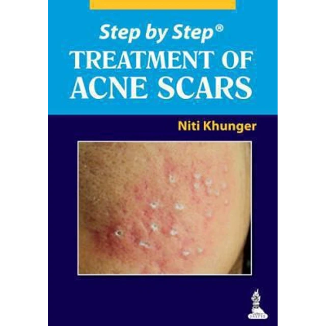 Treatment of Acne Scars