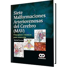 Siete malformaciones arteriovenosas del cerebro (MAV)