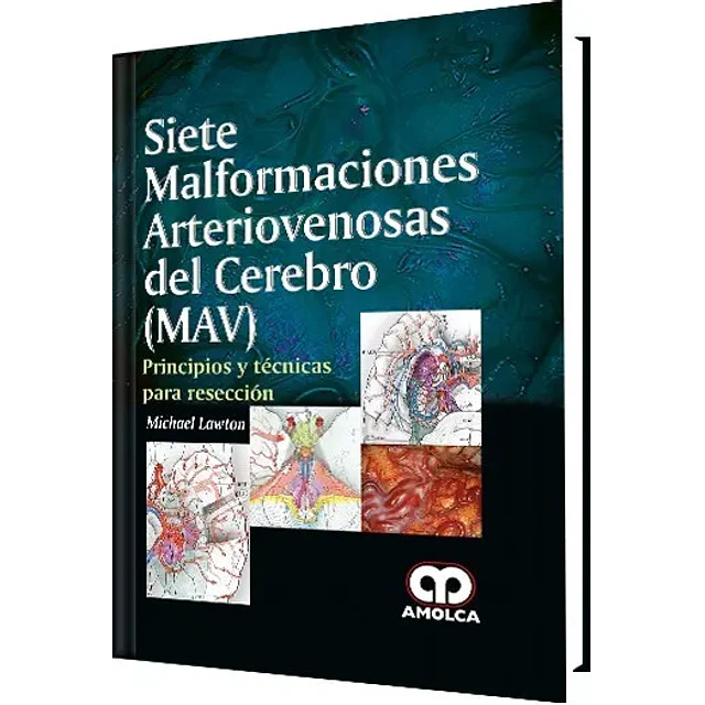 Siete malformaciones arteriovenosas del cerebro (MAV)