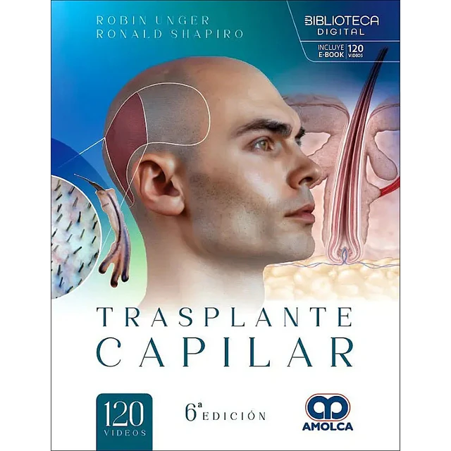 Trasplante capilar