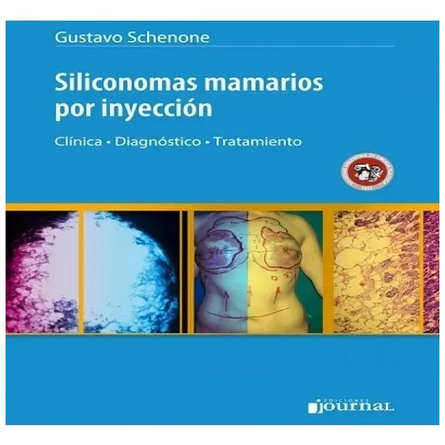 Siliconomas mamarios por inyección. Clínica, diagnóstico, tratamiento