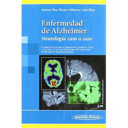 Enfermedad de Alzheimer