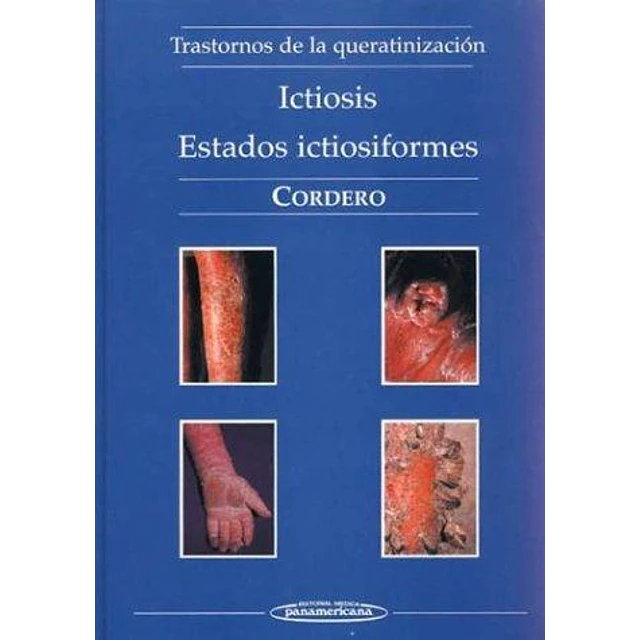 Ictiosis : estados ictiosiformes : trastornos de la queratinizacion
